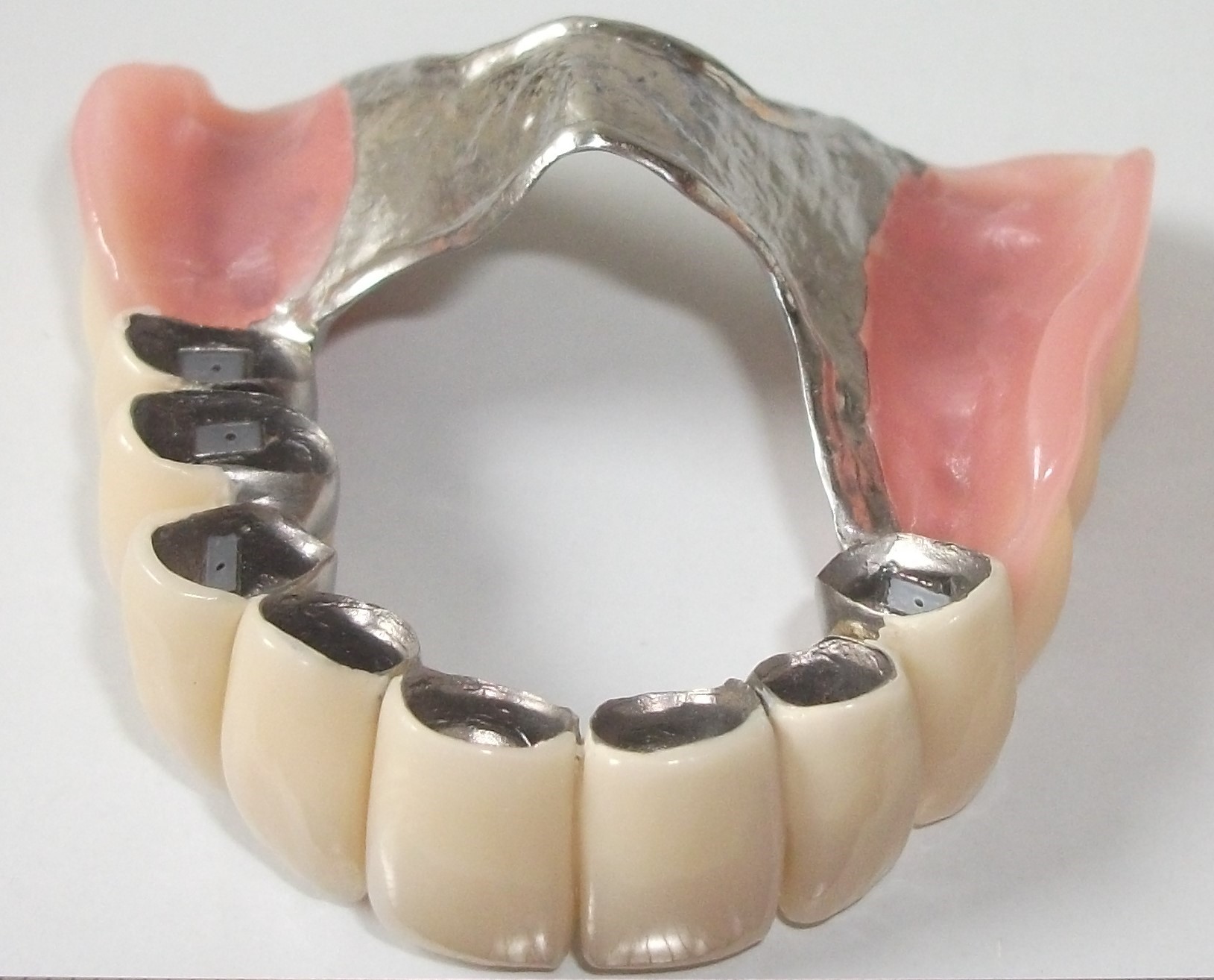 Zahnprothese oberkiefer ohne gaumenplatte.